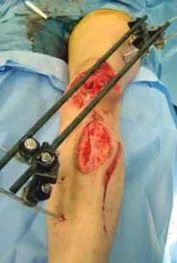 تفاصيل مرئية 58 - التثبيت الخارجي للقصبة: هكذا يتم وضع مسمارين لكسور معقدة