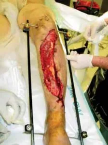 تفاصيل مرئية 17 - التثبيت الخارجي للقصبة: هكذا يتم وضع مسمارين لكسور معقدة