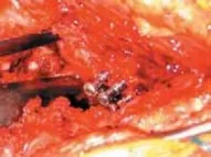 تفاصيل مرئية 27 - الخلاص من آلام سرطان العظام: استبدال مفصل الورك بالداني من الفخذ