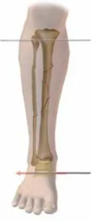 تفاصيل مرئية 64 - التثبيت الخارجي للقصبة: هكذا يتم وضع مسمارين لكسور معقدة