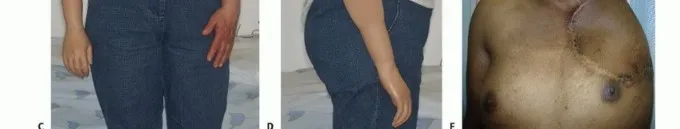 تفاصيل مرئية 47 - بتر الربع الأمامي: كل ما يجب أن تعرفه عن هذا الإجراء المعقد