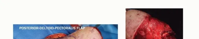 تفاصيل مرئية 18 - بتر الربع الأمامي: كل ما يجب أن تعرفه عن هذا الإجراء المعقد