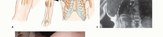 تفاصيل مرئية 5 - بتر الربع الأمامي: كل ما يجب أن تعرفه عن هذا الإجراء المعقد