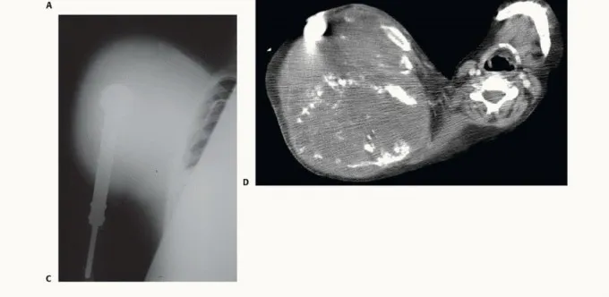 تفاصيل مرئية 8 - بتر الربع الأمامي: كل ما يجب أن تعرفه عن هذا الإجراء المعقد