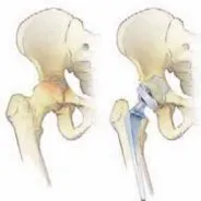 تفاصيل مرئية 8 - الخلاص من آلام سرطان العظام: استبدال مفصل الورك بالداني من الفخذ