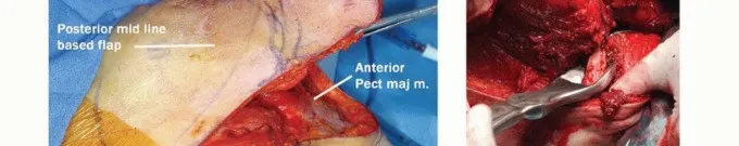 تفاصيل مرئية 19 - بتر الربع الأمامي: كل ما يجب أن تعرفه عن هذا الإجراء المعقد