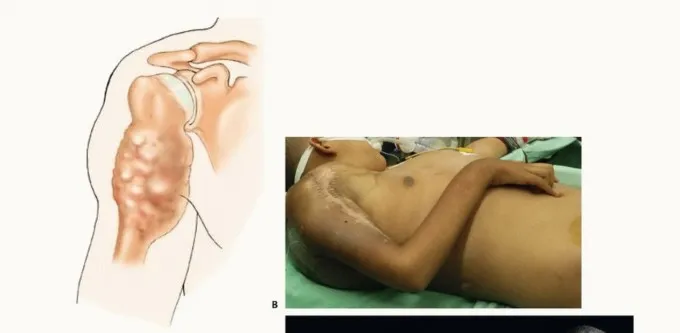 تفاصيل مرئية 7 - بتر الربع الأمامي: كل ما يجب أن تعرفه عن هذا الإجراء المعقد