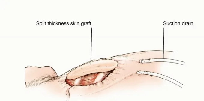 تفاصيل مرئية 44 - بتر الربع الأمامي: كل ما يجب أن تعرفه عن هذا الإجراء المعقد
