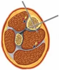 تفاصيل مرئية 15 - التثبيت الخارجي للقصبة: هكذا يتم وضع مسمارين لكسور معقدة