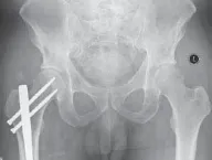 تفاصيل مرئية 25 - الخلاص من آلام سرطان العظام: استبدال مفصل الورك بالداني من الفخذ