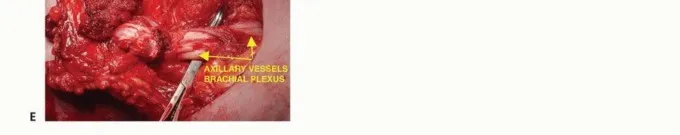 تفاصيل مرئية 21 - بتر الربع الأمامي: كل ما يجب أن تعرفه عن هذا الإجراء المعقد