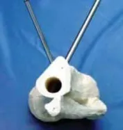 تفاصيل مرئية 16 - التثبيت الخارجي للقصبة: هكذا يتم وضع مسمارين لكسور معقدة