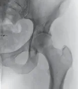 تفاصيل مرئية 32 - الفخذي المنعطف الانسي: ركيزة أمانك في خلع الورك الجراحي