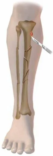 تفاصيل مرئية 26 - التثبيت الخارجي للقصبة: هكذا يتم وضع مسمارين لكسور معقدة