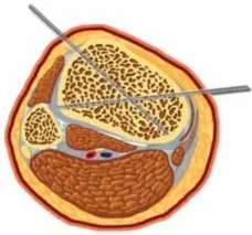 تفاصيل مرئية 12 - التثبيت الخارجي للقصبة: هكذا يتم وضع مسمارين لكسور معقدة