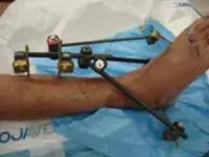 تفاصيل مرئية 61 - التثبيت الخارجي للقصبة: هكذا يتم وضع مسمارين لكسور معقدة