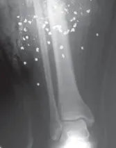 تفاصيل مرئية 54 - التثبيت الخارجي للقصبة: هكذا يتم وضع مسمارين لكسور معقدة