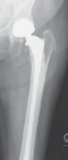 تفاصيل مرئية 14 - الخلاص من آلام سرطان العظام: استبدال مفصل الورك بالداني من الفخذ