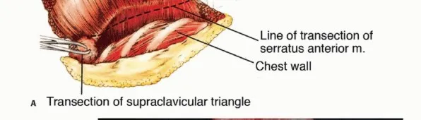 تفاصيل مرئية 30 - بتر الربع الأمامي: كل ما يجب أن تعرفه عن هذا الإجراء المعقد