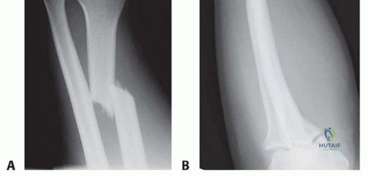 Orthopedic Surgery Board Review MCQs: AAOS Master Bank Part 11