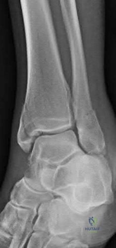 Orthopedic Surgery Board Review MCQs: AAOS Master Bank Part 111