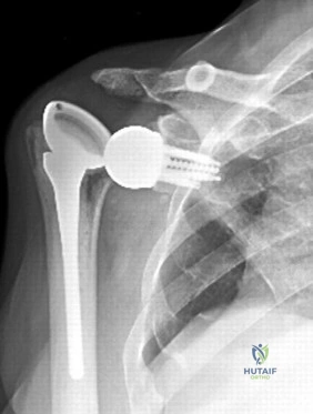 Orthopedic Surgery Board Review MCQs: AAOS Master Bank Part 119