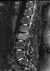 Orthopedic Board Review MCQs: Spine, Hip, & Shoulder | Part 123