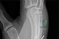 Illustration of spanning external fixation - Dr. Mohammed Hutaif