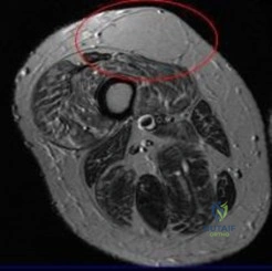 Orthopedic Surgery Board Review MCQs: AAOS Master Bank Part 245