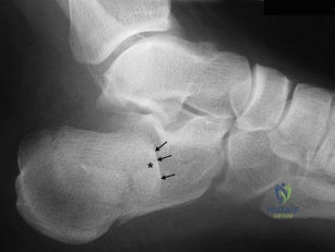 Orthopedic Guide: Kocher and Kaplan Surgical Approaches to the Elbow