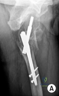 Orthopedic Surgery Board Review MCQs: AAOS Master Bank Part 95