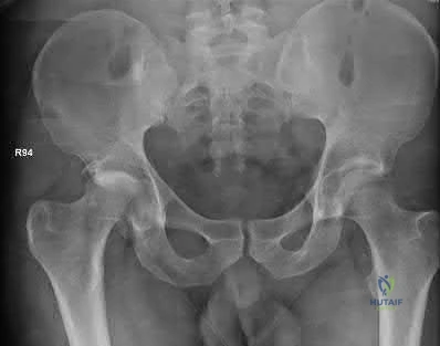OITE & ABOS Orthopedic Board Prep: Practice Exam Part 104