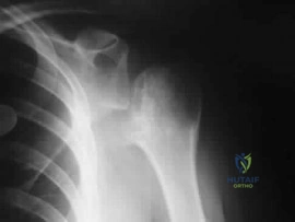 OITE & ABOS Orthopedic Board Prep: Practice Exam Part 110