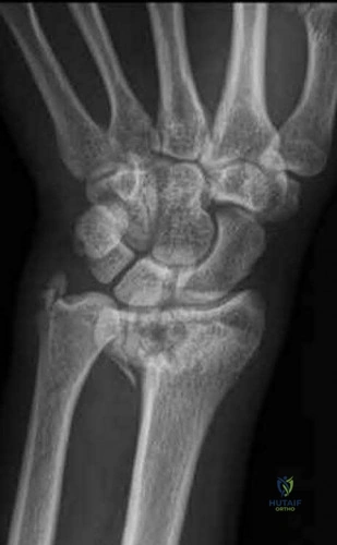 OITE & ABOS Orthopedic Board Prep: Practice Exam Part 134