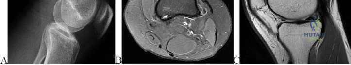 OITE & ABOS Orthopedic Board Prep: Adult Reconstruction, Trauma & Upper Extremity MCQs Part 140