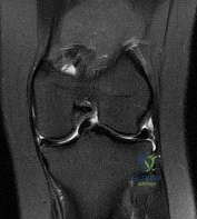 OITE & ABOS Orthopedic Board Prep: Practice Exam Part 184