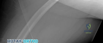 OITE & ABOS Orthopedic Board Prep: Practice Exam Part 212