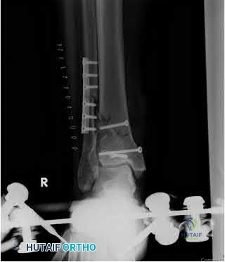 OITE & ABOS Orthopedic Board Prep: Practice Exam Part 222
