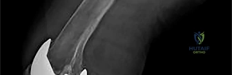 OITE & ABOS Orthopedic Board Prep: Practice Exam Part 250