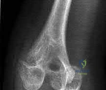 OITE & ABOS Orthopedic Board Prep: Practice Exam Part 50