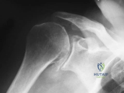 OITE & ABOS Orthopedic Board Prep: Practice Exam Part 84