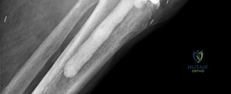 OITE & ABOS Orthopedic Board Prep: Practice Exam Part 98