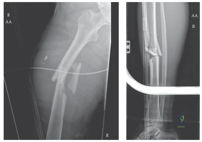 Illustration of floating knee floating - Dr. Mohammed Hutaif