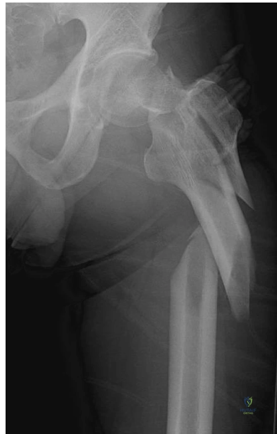 Illustration of neck and shaft - Dr. Mohammed Hutaif