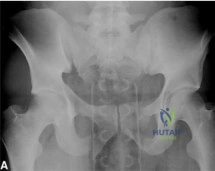 الدليل الشامل لعلاج إصابات الأنسجة الرخوة المعقدة في الطرف العلوي