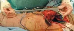 صور توضيحية لعملية استبدال مفصل الورك الكلي للآفات الخبيثة