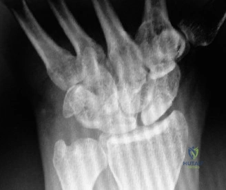 Illustration of degrees with forearm - Dr. Mohammed Hutaif