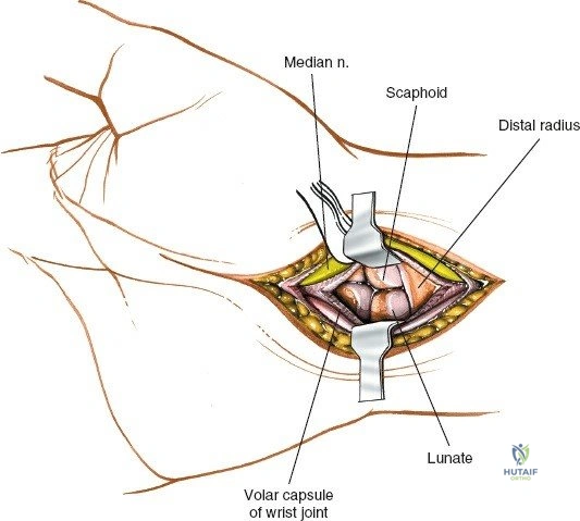 Figure 5-21 The incision for the volar approach to the wrist. The incision should be made on the ulnar side of the palmaris longus tendon to protect the palmar cutaneous branch of the median nerve.