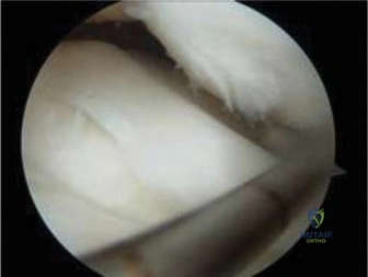 صورة توضيحية لـ التهاب العظم والغضروف السالخ وإصابات الركبة الأخرى لدى الأطفال: دليل شامل للآباء