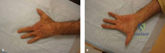 صورة توضيحية لـ استعادة حركة اليد الكاملة بعد الإصابات جراحة متقدمة وإعادة تأهيل شاملة